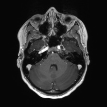 Cerebral cavernous venous malformation (Radiopaedia 70008-80021 Axial T1 C+ 16).jpg