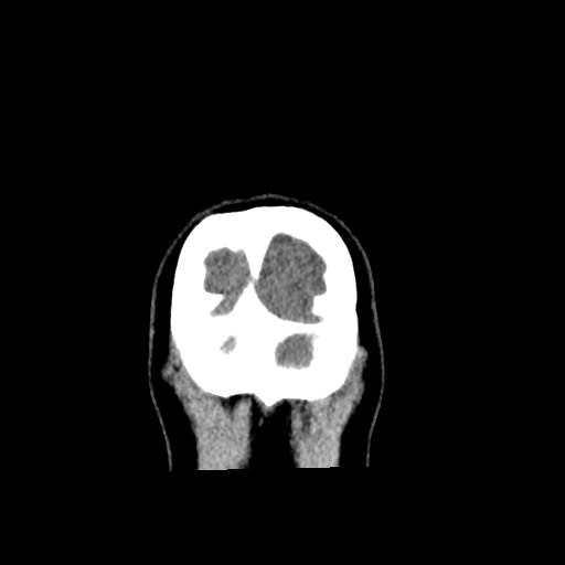 Cerebral cavernous venous malformation (Radiopaedia 70008-80022 non-contrast 68).jpg