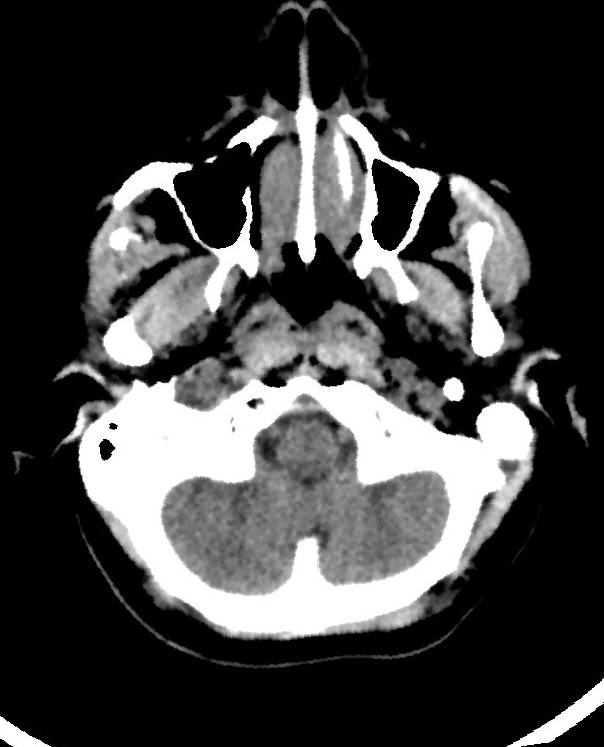 Cerebral edema due to severe hyponatremia (Radiopaedia 89826-106938 Axial non-contrast 15).jpg