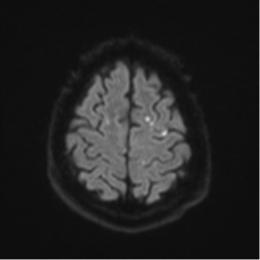 Cerebral embolic infarcts (embolic shower) (Radiopaedia 57395-64342 Axial DWI 66).png