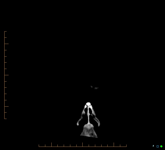 Cerebral fat embolism (Radiopaedia 85521-101220 Coronal non-contrast 1).jpg