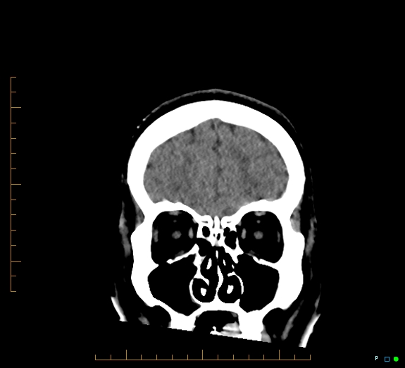 Cerebral fat embolism (Radiopaedia 85521-101220 Coronal non-contrast 14).jpg