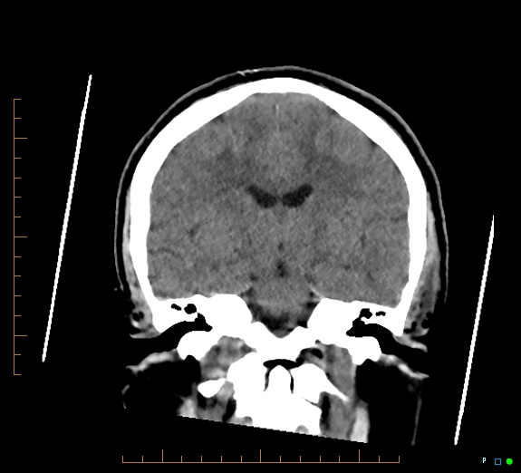 Cerebral fat embolism (Radiopaedia 85521-101220 Coronal non-contrast 34).jpg