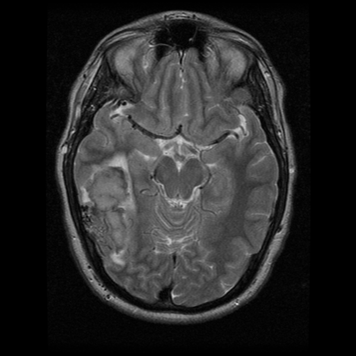 File:Cerebral hemorrhage secondary to arteriovenous malformation (Radiopaedia 33497-34572 Axial T2 10).png