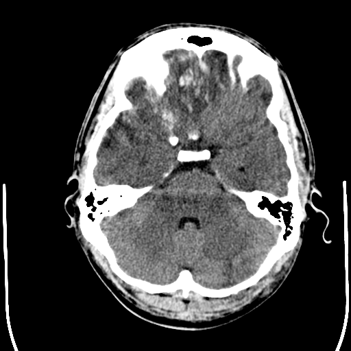 File:Cerebral hemorrhagic contusions- temporal evolution (Radiopaedia 40224-42754 Axial non-contrast 7).png