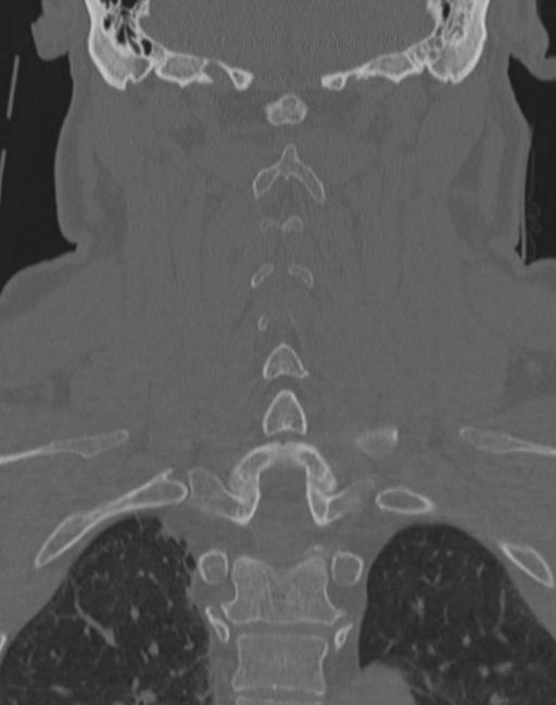 Cerebral hemorrhagic contusions and cervical spine fractures (Radiopaedia 32865-33841 Coronal bone window 49).jpg