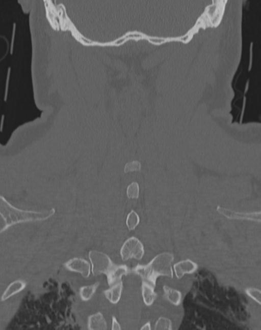 Cerebral hemorrhagic contusions and cervical spine fractures (Radiopaedia 32865-33841 Coronal bone window 60).jpg