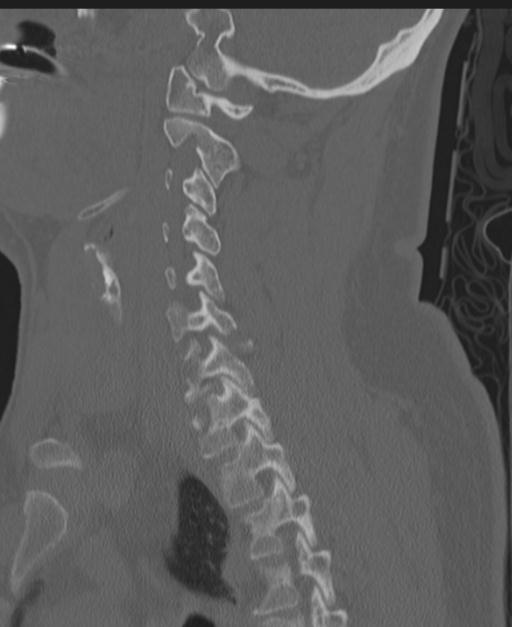 Cerebral hemorrhagic contusions and cervical spine fractures (Radiopaedia 32865-33841 Sagittal bone window 62).jpg