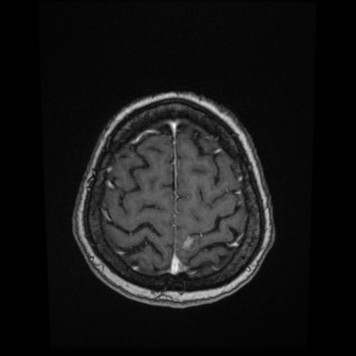 Cerebral metastases - melanoma (Radiopaedia 80972-94522 Axial T1 C+ 79).jpg