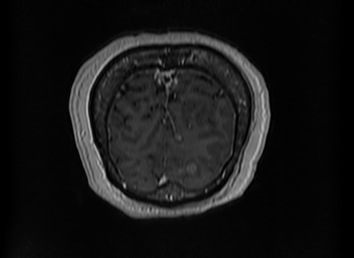 Cerebral metastases from lung cancer with amyloid angiopathy and cerebellopontine angle meningioma (Radiopaedia 74306-85191 Coronal T1 C+ 57).jpg