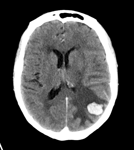 File:Cerebral metastasis (Radiopaedia 46744-51260 Axial C+ delayed 17).png