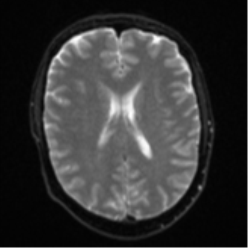 Cerebral metastasis - colorectal adenocarcinoma (Radiopaedia 50394-55765 Axial DWI 16).png