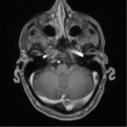 Cerebral metastasis - melanoma (Radiopaedia 54718-60954 Axial T1 C+ fat sat 13).png