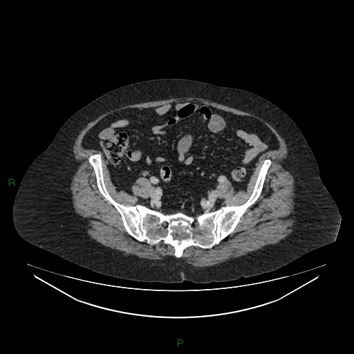 Cerebral metastasis from renal cell carcinoma (Radiopaedia 82306-96378 A 143).jpg