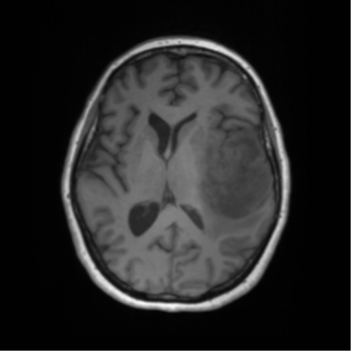 File:Cerebral metastasis mimicking glioblastoma (Radiopaedia 69155-78937 Axial T1 35).png