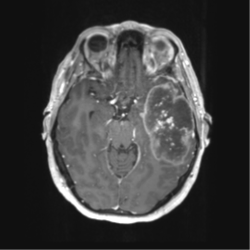 File:Cerebral metastasis mimicking glioblastoma (Radiopaedia 69155-78937 Axial T1 C+ 22).png
