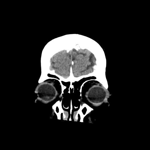 Cerebral metastasis to basal ganglia (Radiopaedia 81568-95412 Coronal non-contrast 13).png