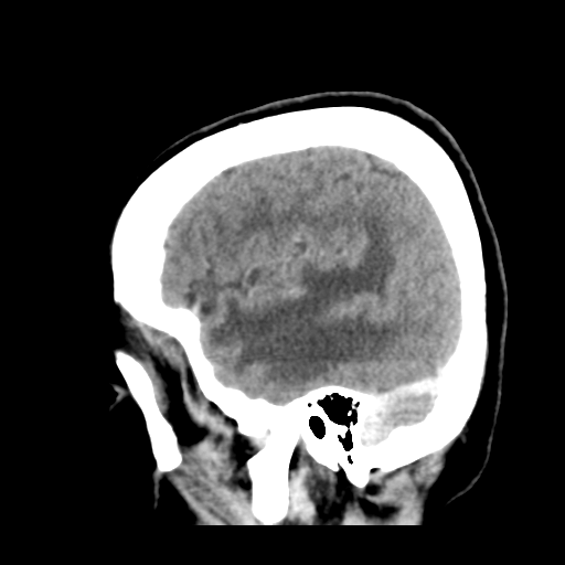 Cerebral metastasis to basal ganglia (Radiopaedia 81568-95412 Sagittal C+ delayed 13).png