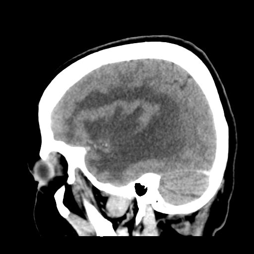Cerebral metastasis to basal ganglia (Radiopaedia 81568-95412 Sagittal C+ delayed 16).png