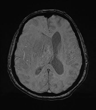 Cerebral metastasis to basal ganglia (Radiopaedia 81568-95413 Axial SWI 51).png