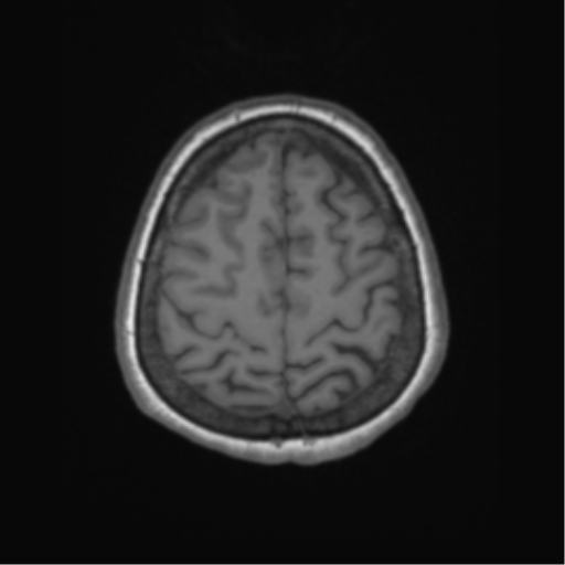 File:Cerebral metastasis to basal ganglia (Radiopaedia 81568-95413 Axial T1 61).png