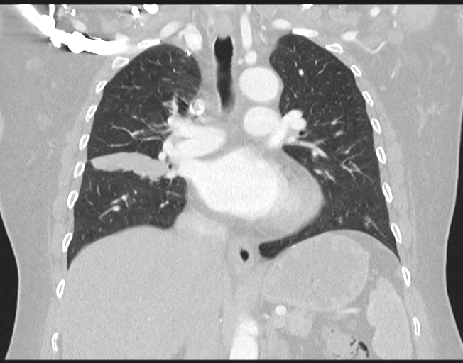 File:Cerebral metastasis to basal ganglia (Radiopaedia 81568-95414 Coronal lung window 45).png
