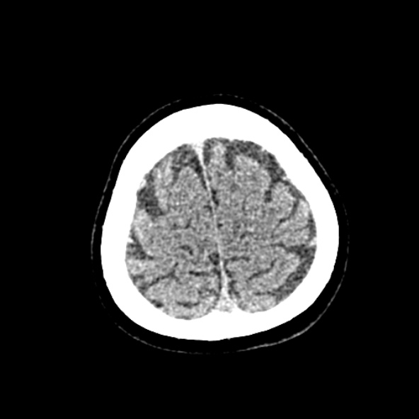 File:Cerebral ring enhancing lesions - cerebral metastases (Radiopaedia 44922-48818 Axial non-contrast 79).jpg