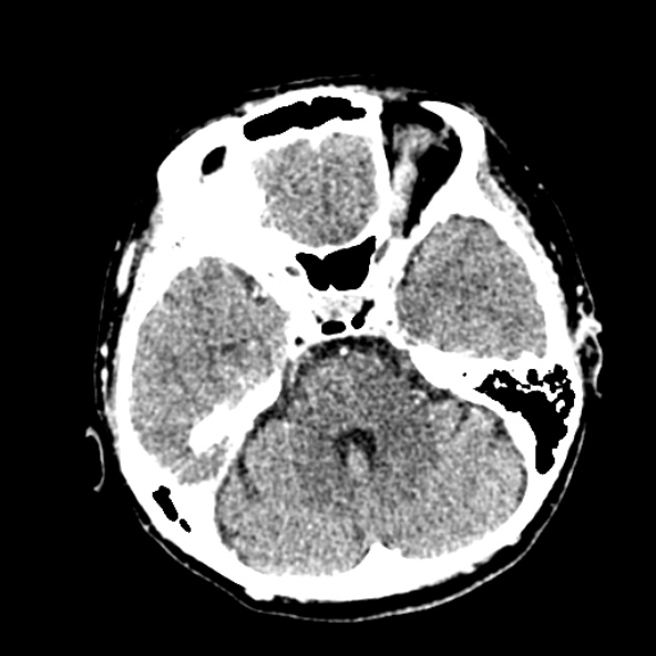 Cerebral ring enhancing lesions - cerebral metastases (Radiopaedia 44922-48818 B 91).jpg