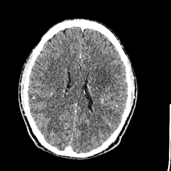 File:Cerebral toxoplasmosis (Radiopaedia 53993-60131 Axial C+ delayed 45).jpg