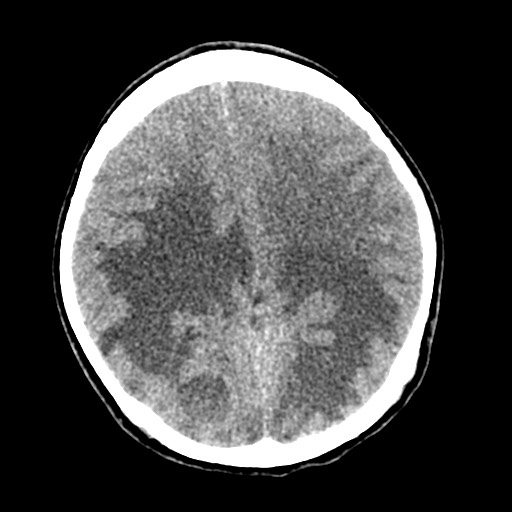 Cerebral tuberculosis with dural sinus invasion (Radiopaedia 60353-68018 Axial non-contrast 38).jpg