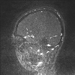 Cerebral tuberculosis with dural sinus invasion (Radiopaedia 60353-68090 Sagittal MRV 117).jpg