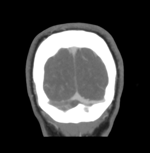 Cerebral venous hemorrhagic infarction (Radiopaedia 38461-40550 Coronal MIP VENOGRAM 54).png