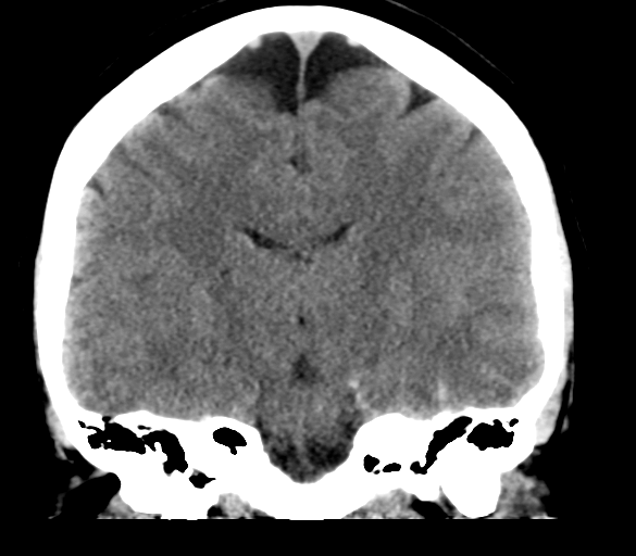 File:Cerebral venous infarction due to transverse sinus thrombosis (Radiopaedia 34688-36116 Coronal non-contrast 20).png