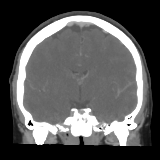 File:Cerebral venous infarction due to transverse sinus thrombosis (Radiopaedia 34688-36120 Coronal 31).png