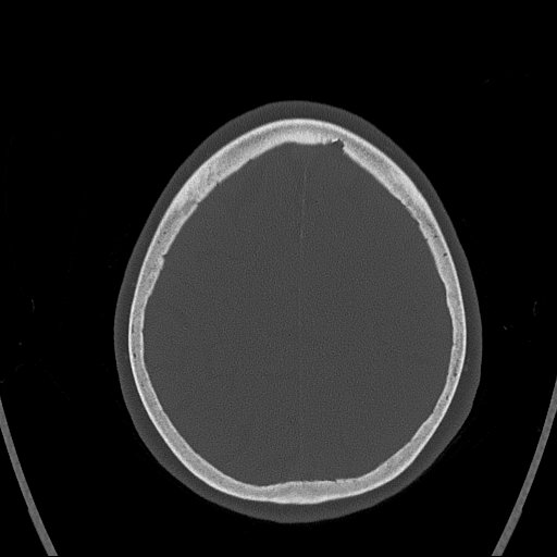 Cerebral venous infarction with hemorrhage (Radiopaedia 65343-74381 Axial bone window 149).jpg