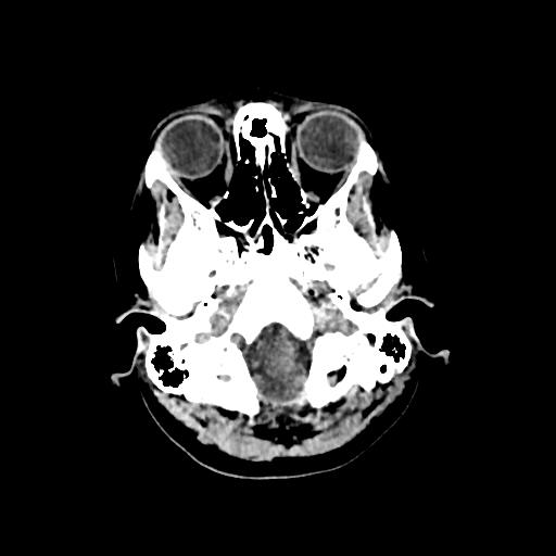 File:Cerebral venous throbmosis - hemorrhagic venous infarction (Radiopaedia 87318-103613 Axial non-contrast 20).jpg