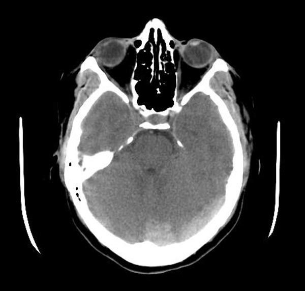 File:Cerebral venous thrombosis (Radiopaedia 11289-11653 Axial non-contrast 1).jpg