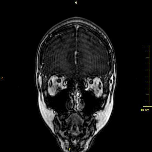 File:Cerebral venous thrombosis (Radiopaedia 23288-23351 MRV 7).JPG