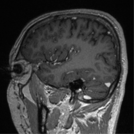 Cerebral venous thrombosis (Radiopaedia 38392-40469 Sagittal T1 C+ 66).png