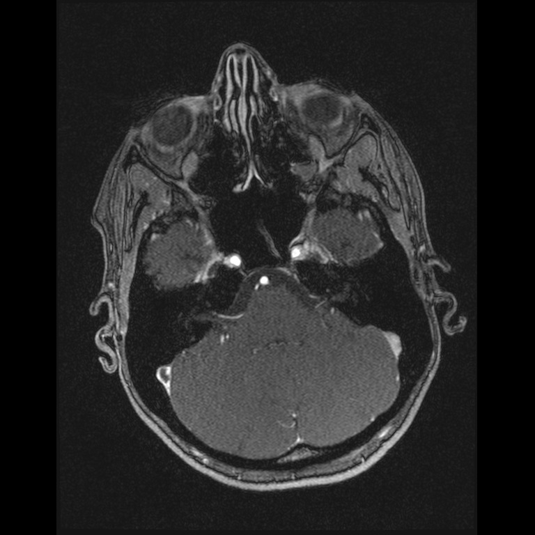 Cerebral venous thrombosis (Radiopaedia 45678-49854 Axial MRV 14).jpg