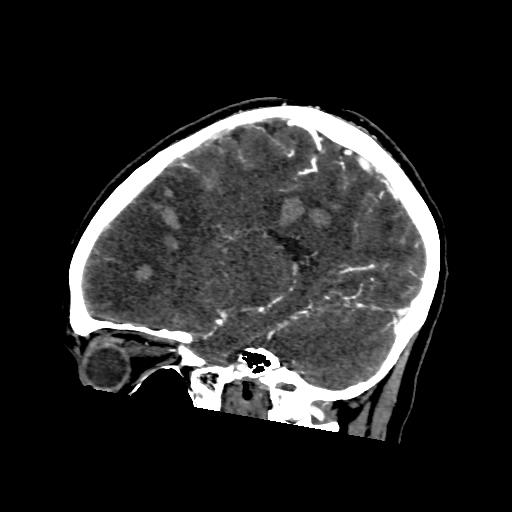 File:Cerebral venous thrombosis - hemorrhagic venous infarction (Radiopaedia 87318-103613 Sagittal 16).jpg