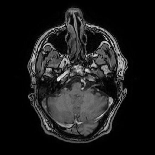 File:Cerebral venous thrombosis with secondary intracranial hypertension (Radiopaedia 89842-106957 Axial T1 C+ 54).jpg
