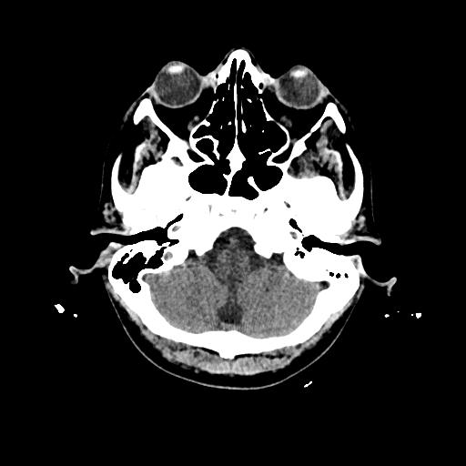 Cerebral venous thrombosis with venous hemorrhagic infarct (Radiopaedia 90354-107660 Axial non-contrast 10).jpg