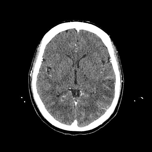 Cerebral venous thrombosis with venous hemorrhagic infarct (Radiopaedia 90354-107660 Axial with contrast 82).jpg