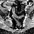 File:Cervical adenocarcinoma (Radiopaedia 65011-73985 Axial ADC 22).jpg