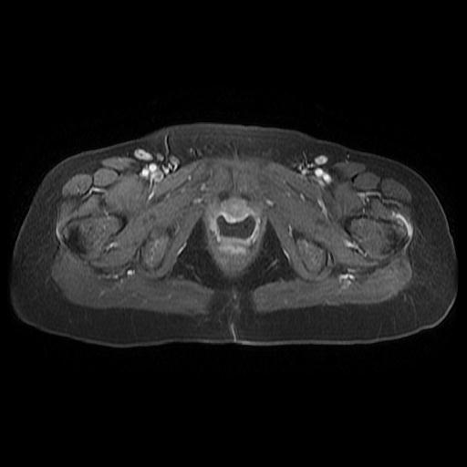 File:Cervical carcinoma (Radiopaedia 67644-77047 Axial T1 C+ fat sat 18).jpg