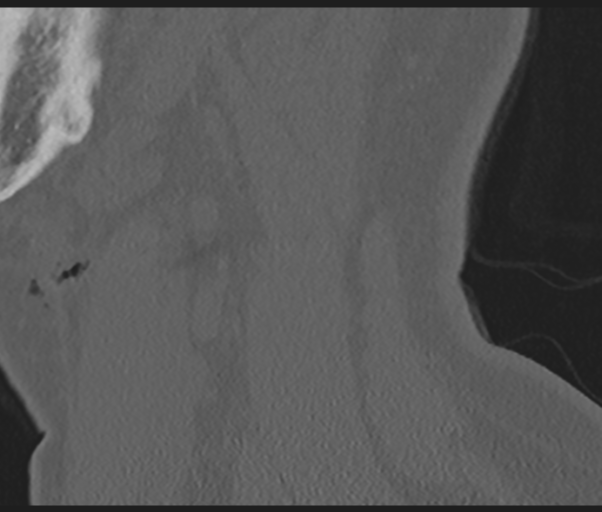 File:Cervical disc replacement (Radiopaedia 44025-47541 Sagittal bone window 73).png