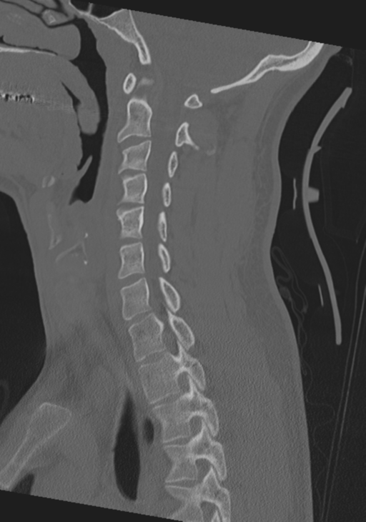 Cervical intercalary bone (Radiopaedia 35211-36748 Sagittal bone window 46).png