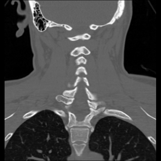 File:Cervical rib (Radiopaedia 71110-81363 Coronal non-contrast 20).jpg