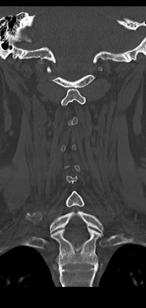 Cervical spine fracture - chalk stick (Radiopaedia 39116-41323 Coronal bone window 34).png